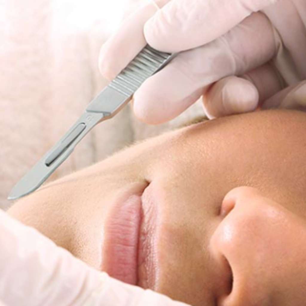 dermaplaning